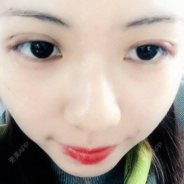 廣州凱美達(dá)微創(chuàng)雙眼皮手術(shù)恢復(fù)期紀(jì)實(shí)