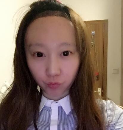 廣州倍生女性發(fā)際線調(diào)整案例