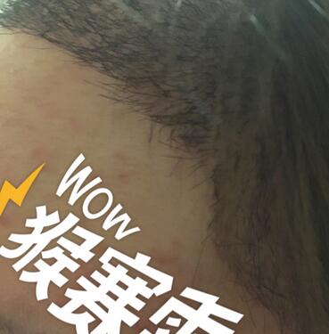 廣州倍生女性發(fā)際線調(diào)整案例