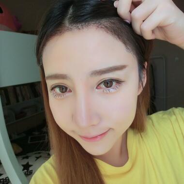 廣州倍生發(fā)際線種植前后對比照片