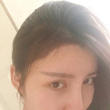 廣州倍生發(fā)際線種植前后對比照片