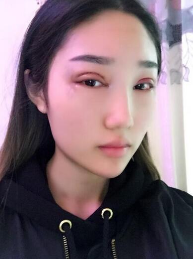 成都蜀尚蓉雅割雙眼皮+開眼角真實案例