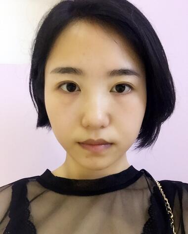 武漢憶美凱德去眼袋手術(shù)后兩個(gè)月照片