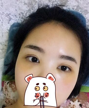 武漢憶美凱德去眼袋手術(shù)后兩個(gè)月照片
