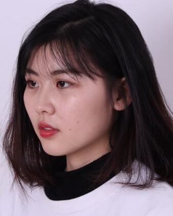 武漢西嬋康美玻尿酸隆鼻恢復(fù)過(guò)程圖