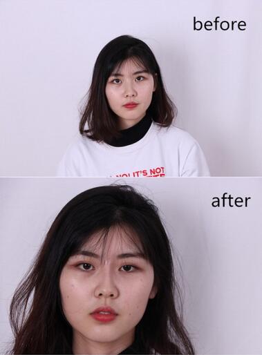 武漢西嬋康美玻尿酸隆鼻恢復(fù)過(guò)程圖