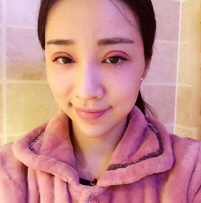 切開雙眼皮恢復(fù)過程分享 杭州東方做雙眼皮2個月