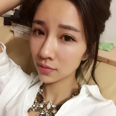 切開雙眼皮恢復(fù)過程分享 杭州東方做雙眼皮2個月