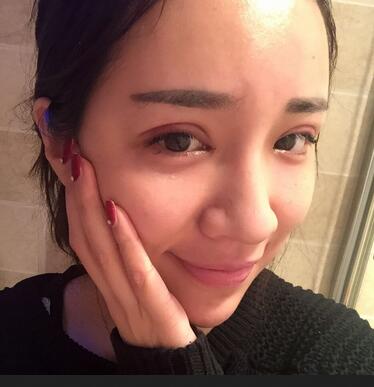 切開雙眼皮恢復(fù)過程分享 杭州東方做雙眼皮2個月