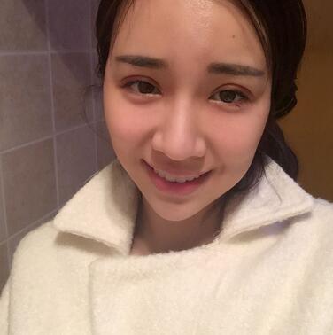 切開雙眼皮恢復(fù)過程分享 杭州東方做雙眼皮2個月