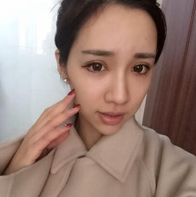 切開雙眼皮恢復(fù)過程分享 杭州東方做雙眼皮2個月