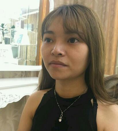 隆鼻整形真實恢復(fù)期圖片 杭州東方隆鼻整形四個月