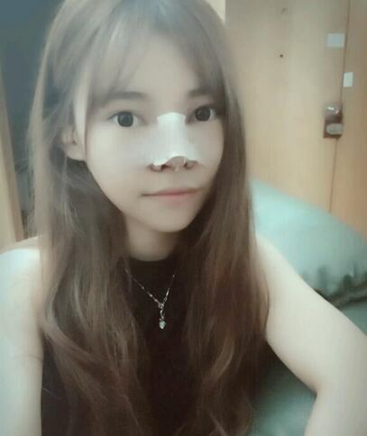 隆鼻整形真實恢復(fù)期圖片 杭州東方隆鼻整形四個月