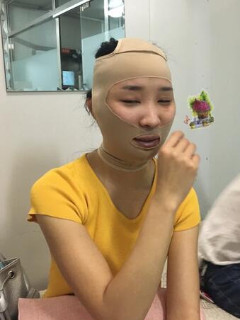 北京八大處張智勇V-line瓜子臉手術(shù)前后對比