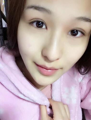 杭州大麥微針龍都整形開(kāi)眼角+割雙眼皮恢復(fù)記錄