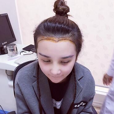 發(fā)際線調(diào)整果對比圖 杭州大麥微針龍都發(fā)際線種植