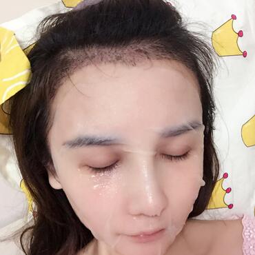 發(fā)際線調(diào)整果對比圖 杭州大麥微針龍都發(fā)際線種植