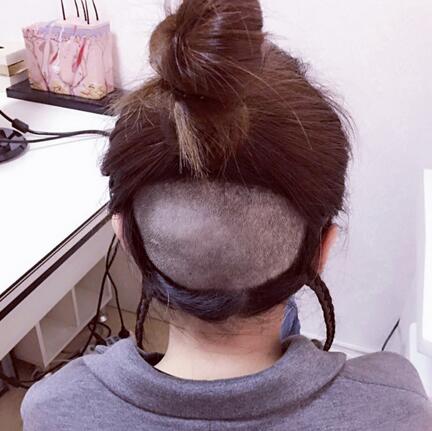 發(fā)際線調(diào)整果對比圖 杭州大麥微針龍都發(fā)際線種植