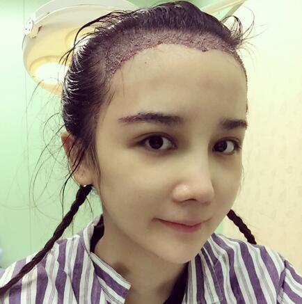 發(fā)際線調(diào)整果對比圖 杭州大麥微針龍都發(fā)際線種植