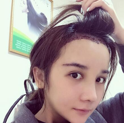 發(fā)際線調(diào)整果對比圖 杭州大麥微針龍都發(fā)際線種植