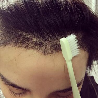 發(fā)際線調(diào)整果對比圖 杭州大麥微針龍都發(fā)際線種植