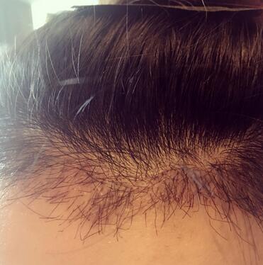 發(fā)際線調(diào)整果對比圖 杭州大麥微針龍都發(fā)際線種植