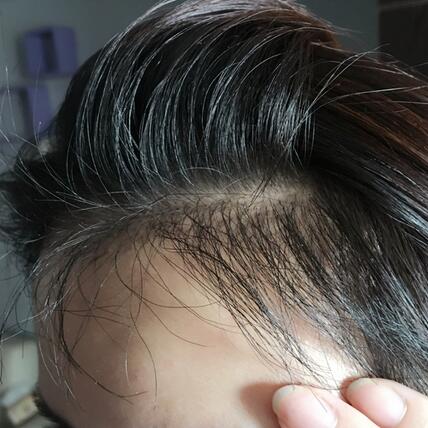 發(fā)際線調(diào)整果對比圖 杭州大麥微針龍都發(fā)際線種植