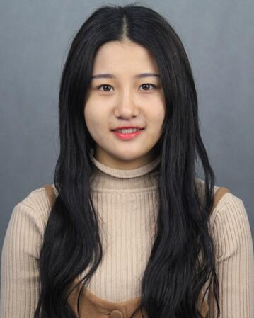 雙眼皮一個月恢復(fù)圖 天津菲絲瀾割雙眼皮兩個月