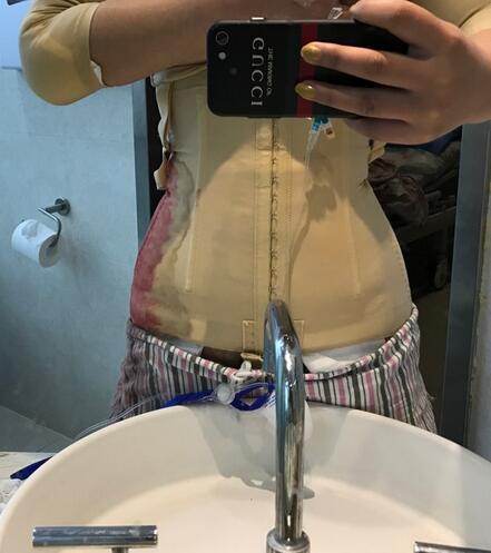 腹部吸脂兩個(gè)月親身經(jīng)歷 深圳仁安雅吸脂案例