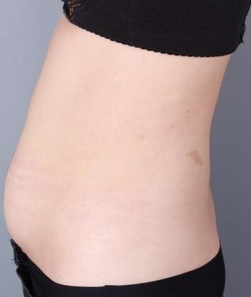 腹部吸脂兩個(gè)月親身經(jīng)歷 深圳仁安雅吸脂案例