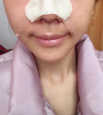 北京藝星王英勇隆鼻案例 隆鼻整形三個月