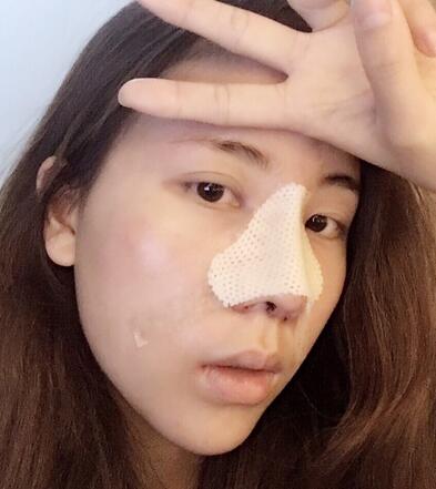 北京藝星王英勇隆鼻案例 隆鼻整形三個月
