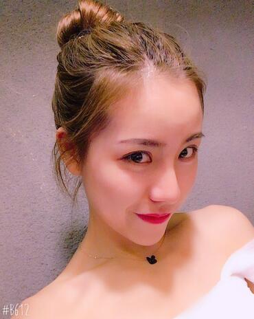 北京藝星王英勇隆鼻案例 隆鼻整形三個月