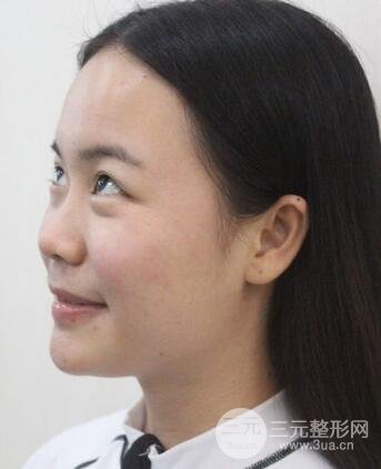 假體隆鼻恢復(fù)過程實(shí)例 前后果對(duì)比