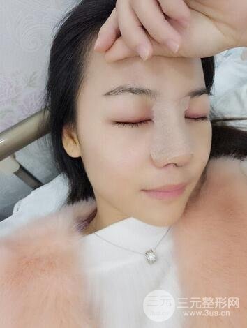 假體隆鼻恢復(fù)過程實(shí)例 前后果對(duì)比