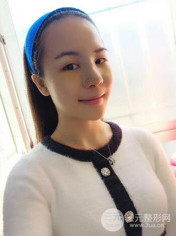 假體隆鼻恢復(fù)過程實(shí)例 前后果對(duì)比