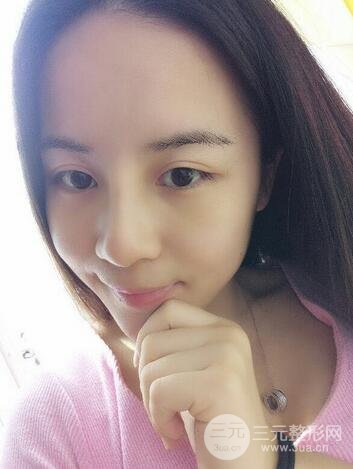 假體隆鼻恢復(fù)過程實(shí)例 前后果對(duì)比