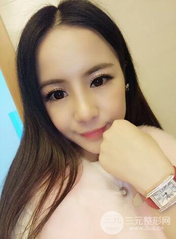 假體隆鼻恢復(fù)過程實(shí)例 前后果對(duì)比