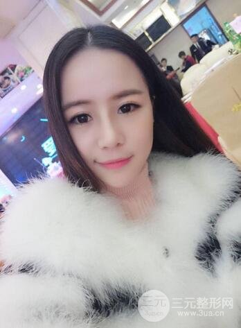 假體隆鼻恢復(fù)過程實(shí)例 前后果對(duì)比