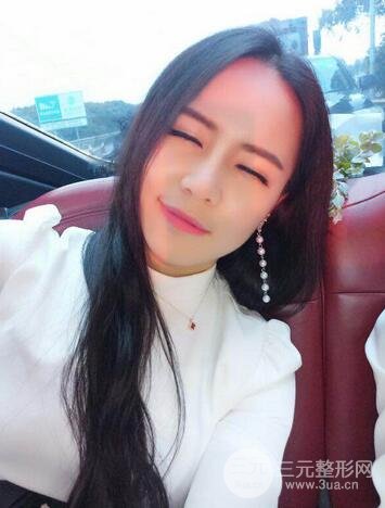 假體隆鼻恢復(fù)過程實(shí)例 前后果對(duì)比