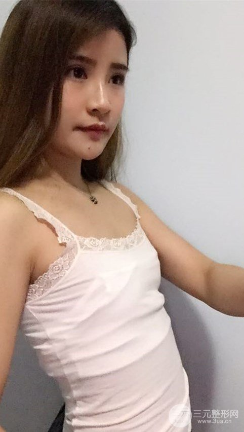 淄博陽光整形自體脂肪隆胸前后對比圖，真實案例