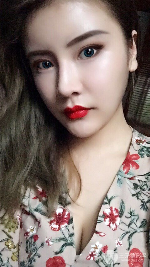 淄博陽光整形自體脂肪隆胸前后對比圖，真實案例