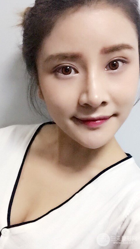 淄博陽光整形自體脂肪隆胸前后對比圖，真實案例