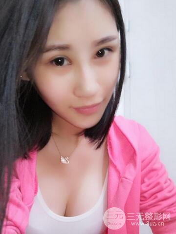 曼托假體+自體脂肪豐胸前后對比 重慶軍美打造果凍胸