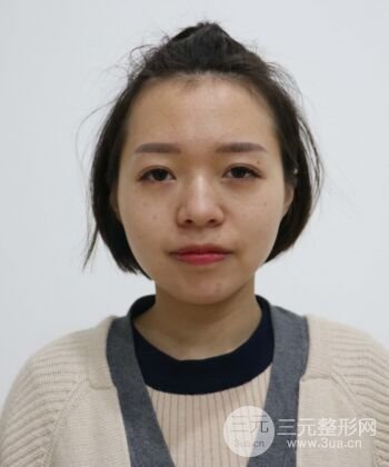 硅膠假體隆鼻+耳軟骨墊鼻尖四個月恢復果圖