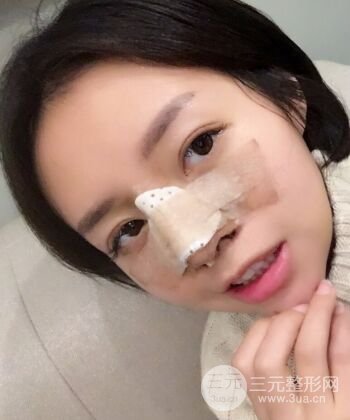 硅膠假體隆鼻+耳軟骨墊鼻尖四個月恢復果圖