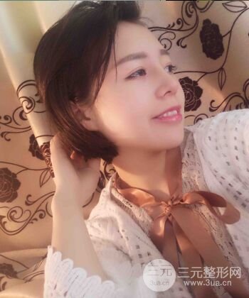 硅膠假體隆鼻+耳軟骨墊鼻尖四個月恢復果圖