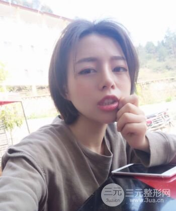 硅膠假體隆鼻+耳軟骨墊鼻尖四個月恢復果圖