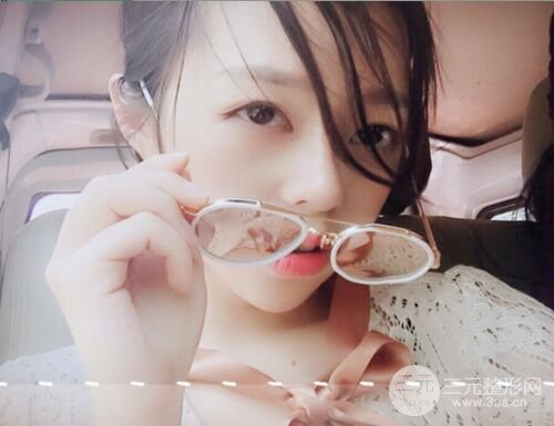 硅膠假體隆鼻+耳軟骨墊鼻尖四個月恢復果圖