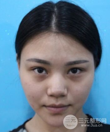 在漢中韓美做了隆鼻整形一個月，恢復越來越自然了